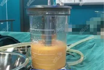曹县360度水动力吸脂费用多少钱？