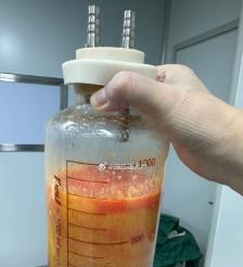 曹县水动力吸脂手术要做多久？